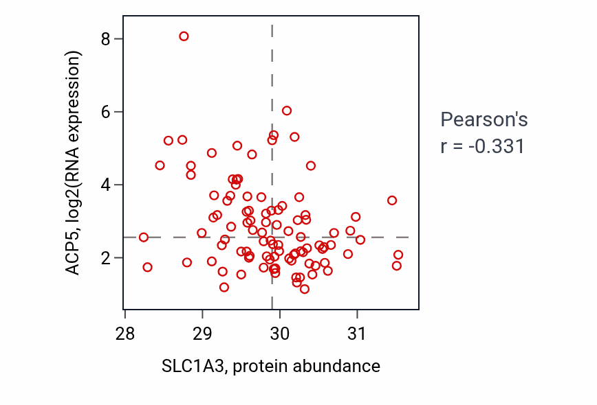 Per-sample scatter of SLC1A3 vs ACP5 in GBM (Pearson r = -0.33).